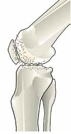 Artróza kolenného klbu 